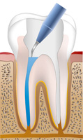 根管治療